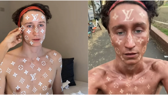 Si abbronza con il logo di Vuitton sulla pelle