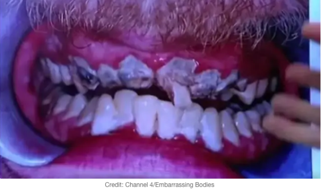 Non si lava i denti per 20 anni