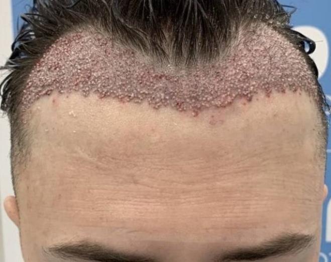  Ragazzo di 26 anni rimasto sfregiato dopo il trapianto dei capelli