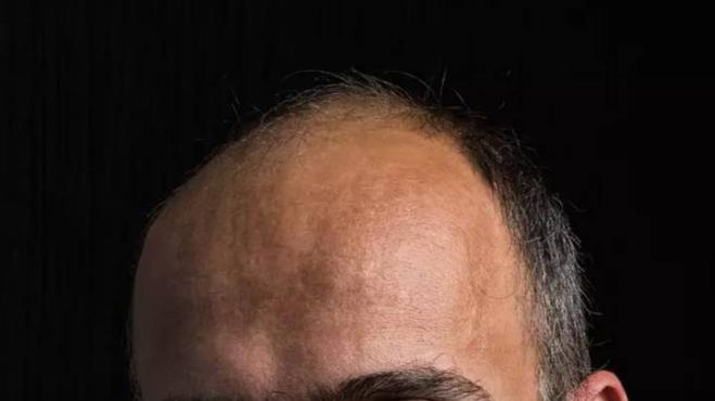 Gli uomini calvi potrebbero essere più a rischio di contrarre il Virus
